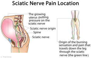Sciatica-Pain-Location